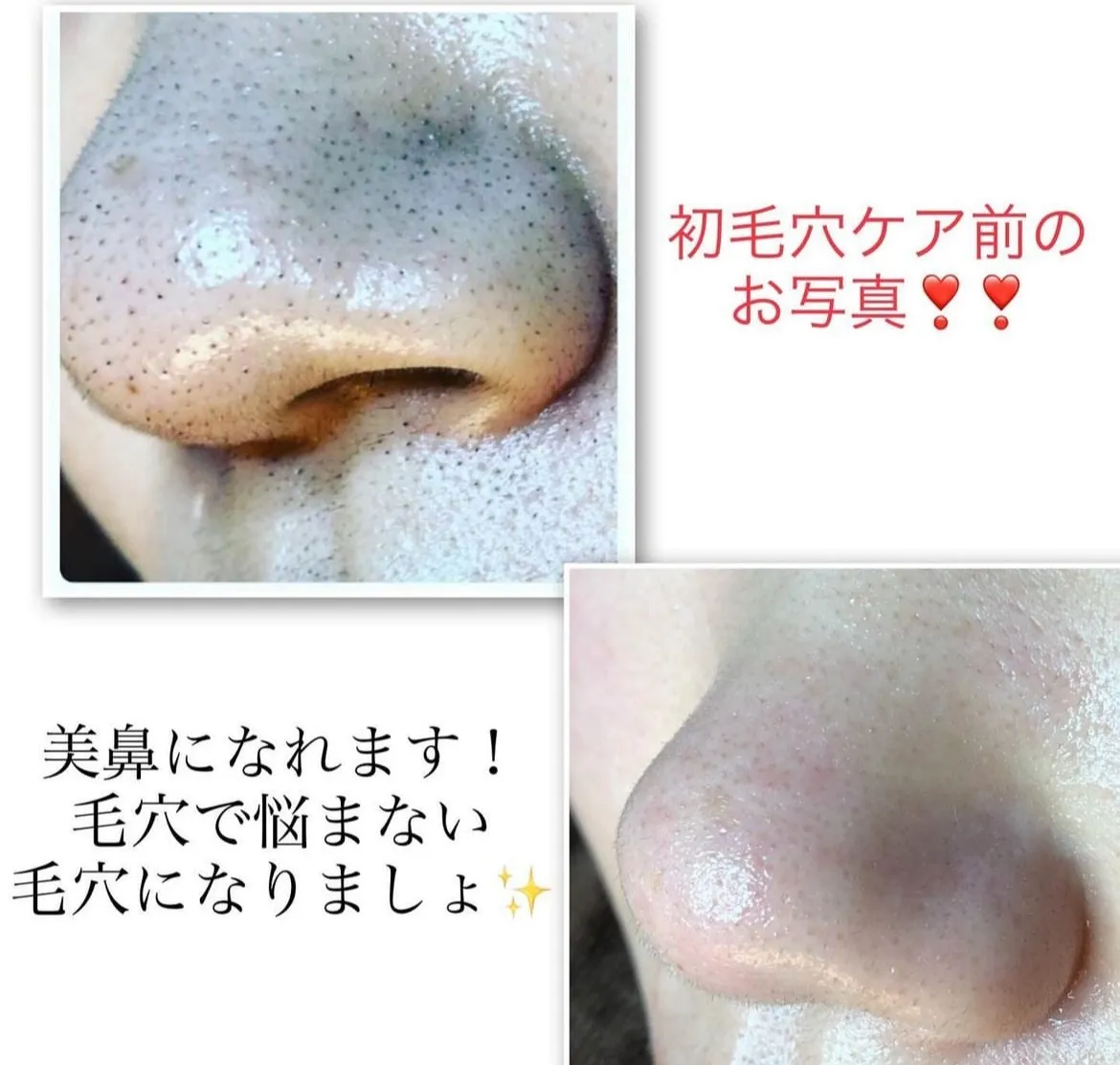 毛穴